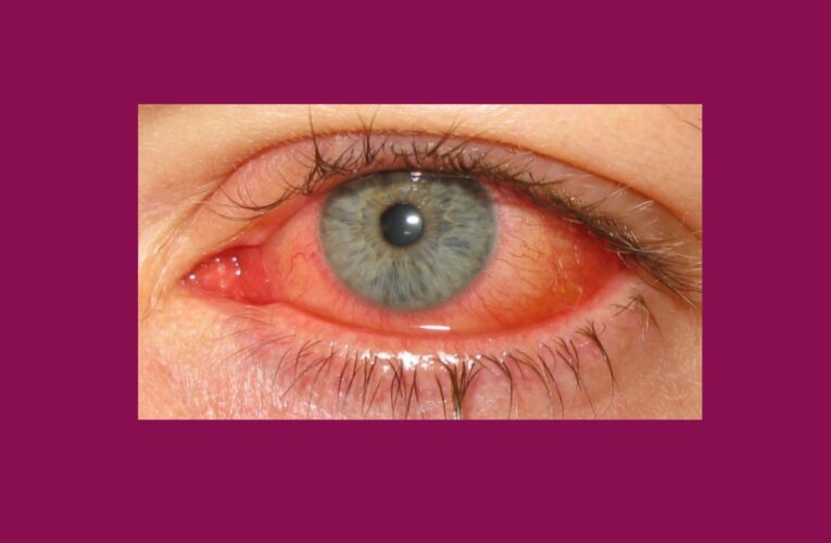 Conjunctivitis in hindi