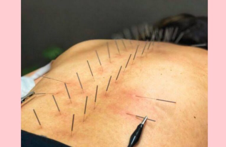 Acupuncture in hindi